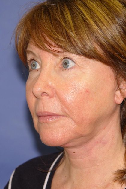 Neck Lift Before & After Patient #1634