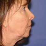 Neck Lift Before & After Patient #1634