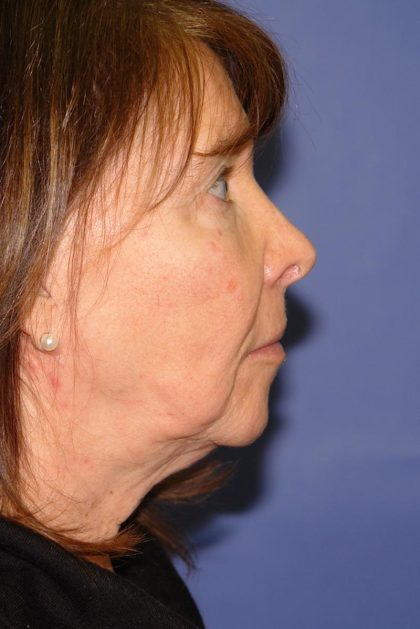 Neck Lift Before & After Patient #1634