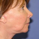 Neck Lift Before & After Patient #1634