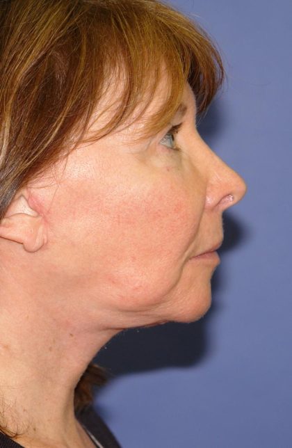 Neck Lift Before & After Patient #1634