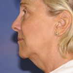Neck Lift Before & After Patient #1635