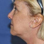 Neck Lift Before & After Patient #1635