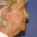 Neck Lift Before & After Patient #1635