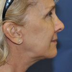 Neck Lift Before & After Patient #1635