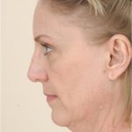 Neck Lift Before & After Patient #1636
