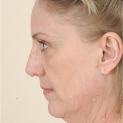 Neck Lift Before & After Patient #1636