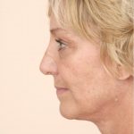 Neck Lift Before & After Patient #1636