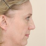 Neck Lift Before & After Patient #1636
