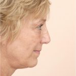 Neck Lift Before & After Patient #1636