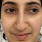 Rhinoplasty Before & After Patient #1044