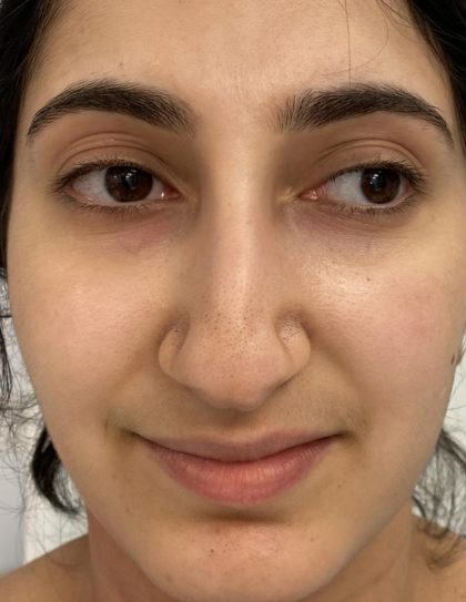 Rhinoplasty Before & After Patient #1044