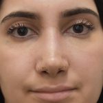Rhinoplasty Before & After Patient #1044