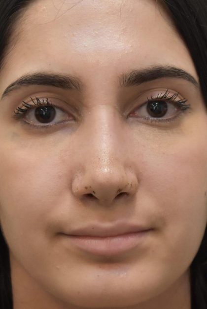 Rhinoplasty Before & After Patient #1044