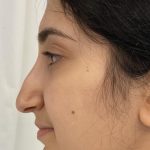 Rhinoplasty Before & After Patient #1044