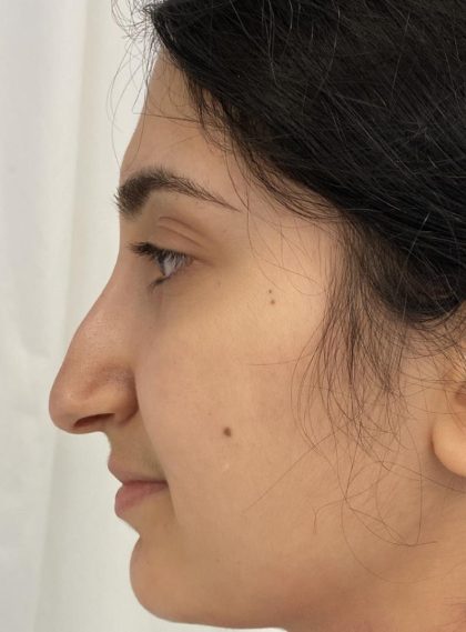 Rhinoplasty Before & After Patient #1044