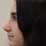 Rhinoplasty Before & After Patient #1044