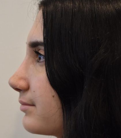 Rhinoplasty Before & After Patient #1044