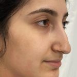 Rhinoplasty Before & After Patient #1044