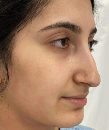 Rhinoplasty Before & After Patient #1044