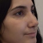 Rhinoplasty Before & After Patient #1044