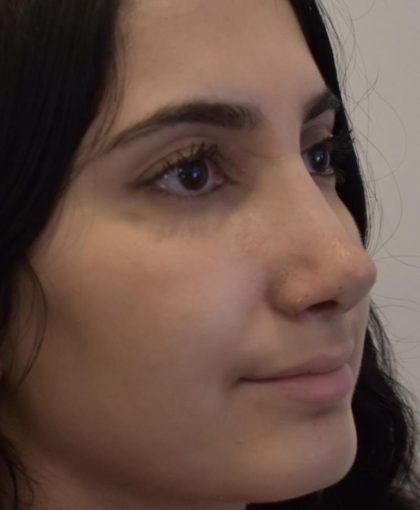 Rhinoplasty Before & After Patient #1044