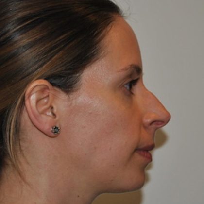 Rhinoplasty Before & After Patient #1036