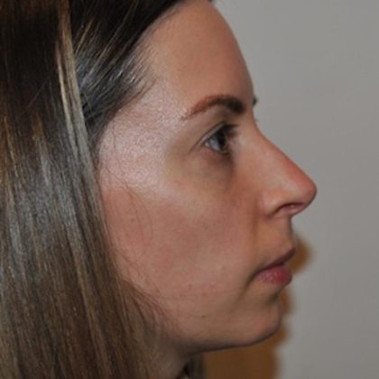 Rhinoplasty Before & After Patient #1036