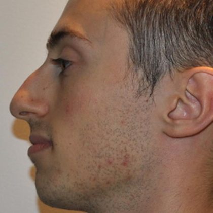 Rhinoplasty Before & After Patient #1037