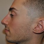 Rhinoplasty Before & After Patient #1037