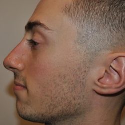 Rhinoplasty Before & After Patient #1037