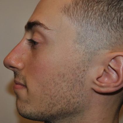 Rhinoplasty Before & After Patient #1037