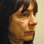 Rhinoplasty Before & After Patient #1038