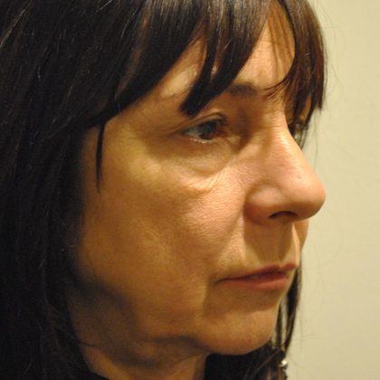 Rhinoplasty Before & After Patient #1038