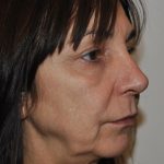 Rhinoplasty Before & After Patient #1038