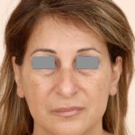 Rhinoplasty Before & After Patient #1039