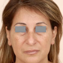 Rhinoplasty Before & After Patient #1039