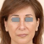 Rhinoplasty Before & After Patient #1039