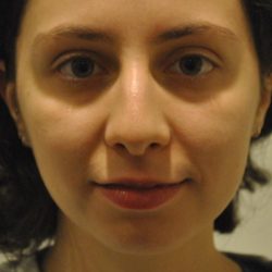 Rhinoplasty Before & After Patient #1041