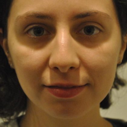 Rhinoplasty Before & After Patient #1041