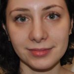 Rhinoplasty Before & After Patient #1041