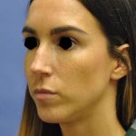 Rhinoplasty Before & After Patient #1042