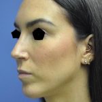 Rhinoplasty Before & After Patient #1042