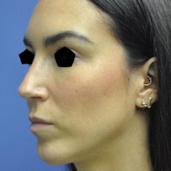 Rhinoplasty Before & After Patient #1042