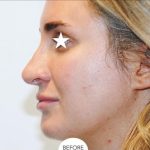 Rhinoplasty Before & After Patient #1043