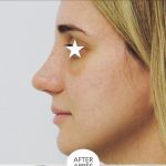 Rhinoplasty Before & After Patient #1043