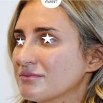 Rhinoplasty Before & After Patient #1043