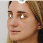 Rhinoplasty Before & After Patient #1043