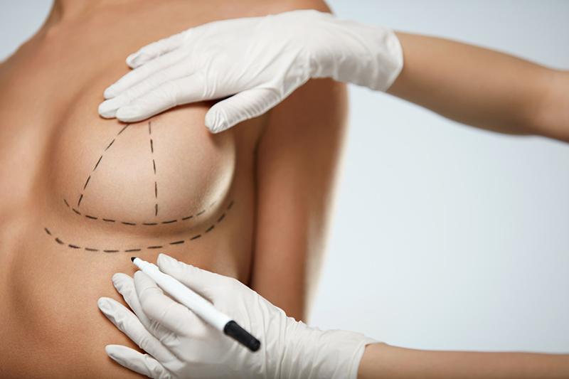 Best Breast Implant Removal Montreal Quebec Dr. Gaby Doumit