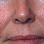 Red Spot Before & After Patient #1045